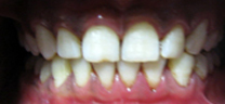 Zoom Advanced Power Whitening - After