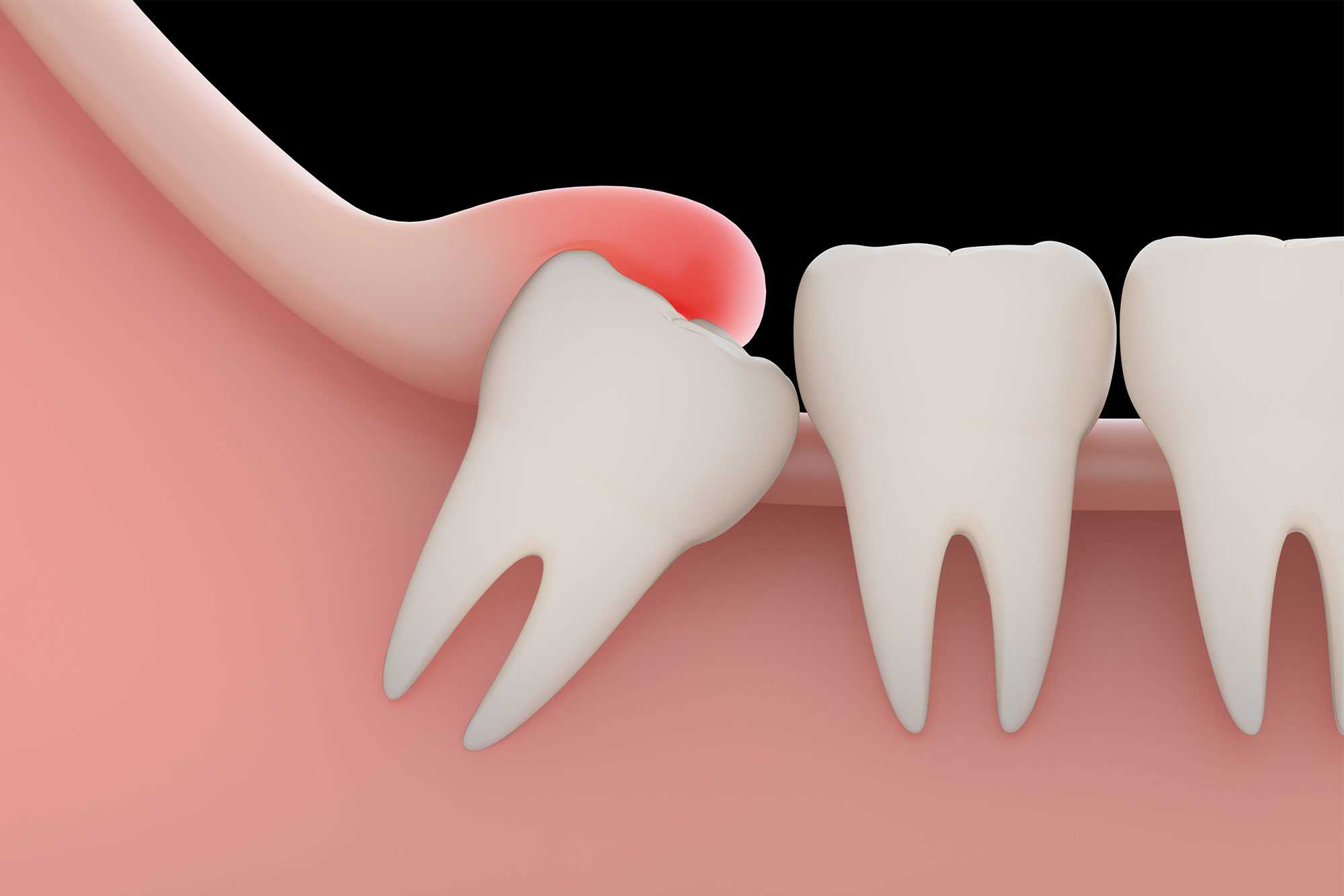 impacted wisdom tooth extraction