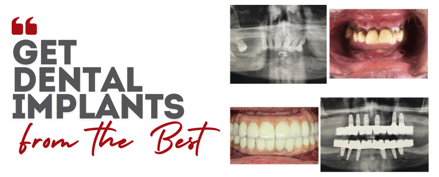 Best Dental Implants Services by Delhi Dental