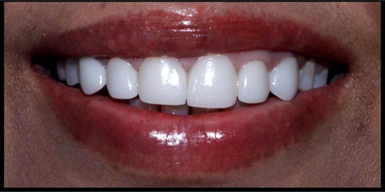 Gap Closure with Metal Free Crowns - After