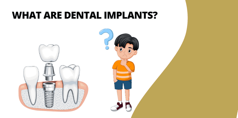 What are Dental Implants