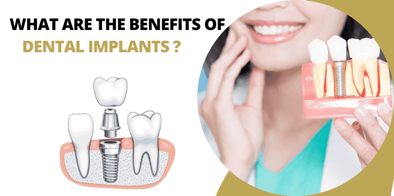 What are the Benefits of Dental Implants