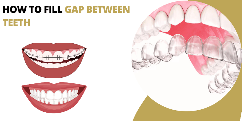 How To Fill Gap Between Teeth