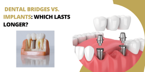 Dental Bridges vs. Implants: Which Lasts Longer?