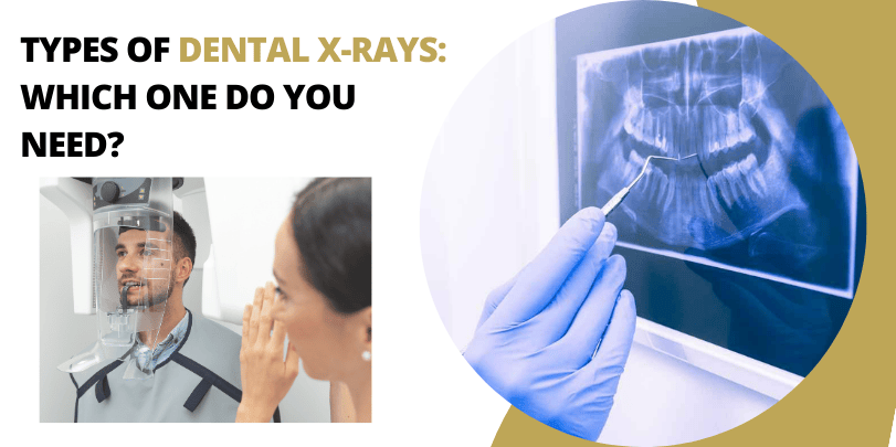 Types of Dental X-Rays: Which One Do You Need?